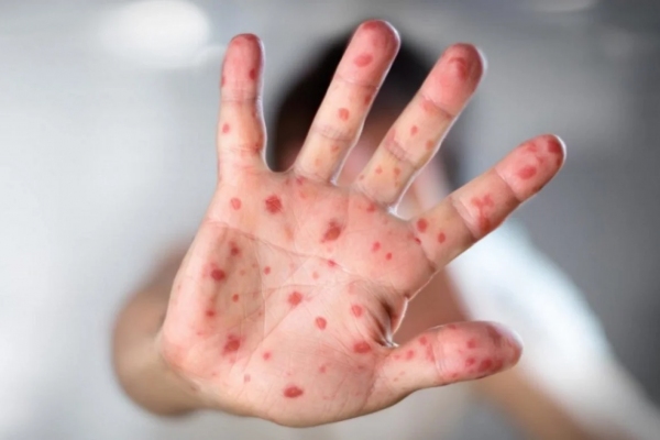 Болезнь Кавасаки. Что это такое, как распознать и как лечить