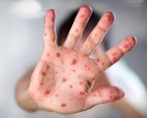 Болезнь Кавасаки. Что это такое, как распознать и как лечить