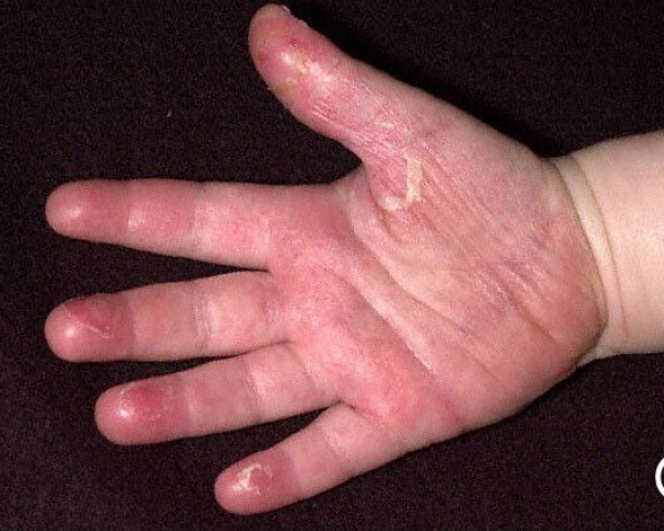 Болезнь Кавасаки. Что это такое, как распознать и как лечить